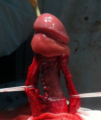 Operation to increase the penis